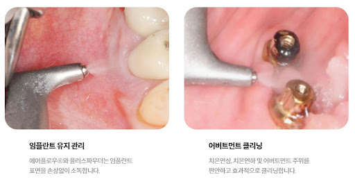 천안 임플란트, 불당본점 서울비디치과의원에서 편안하고 정교한 임플란트 치료 경험