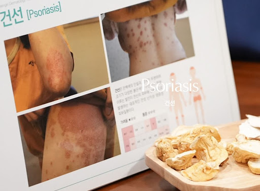 생기한의원 건선 페이지로 확인하는 피부 병변 형태 분류